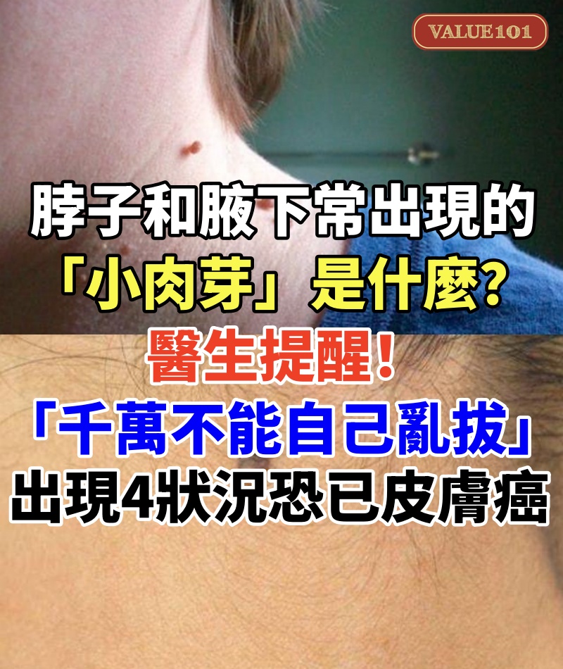 脖子和腋下常出現的「小肉芽」是什麼？　醫生提醒「千萬不能自己亂拔」：若出現4狀況恐已皮膚癌