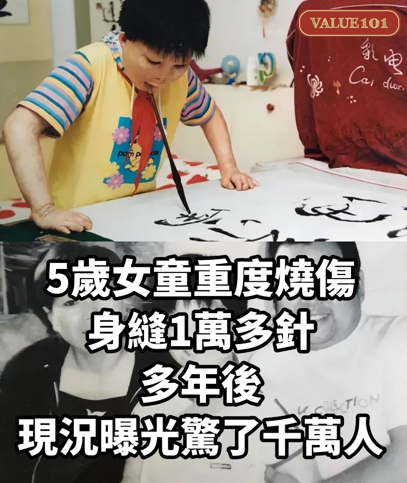 5歲女童重度燒傷，身縫1萬多針，多年後現況曝光驚了千萬人