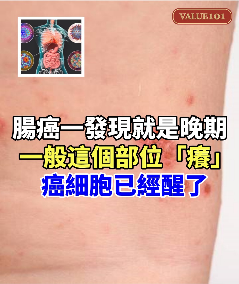 腸癌一發現就是晚期！一般身體這個部位「癢」：癌細胞已經醒了