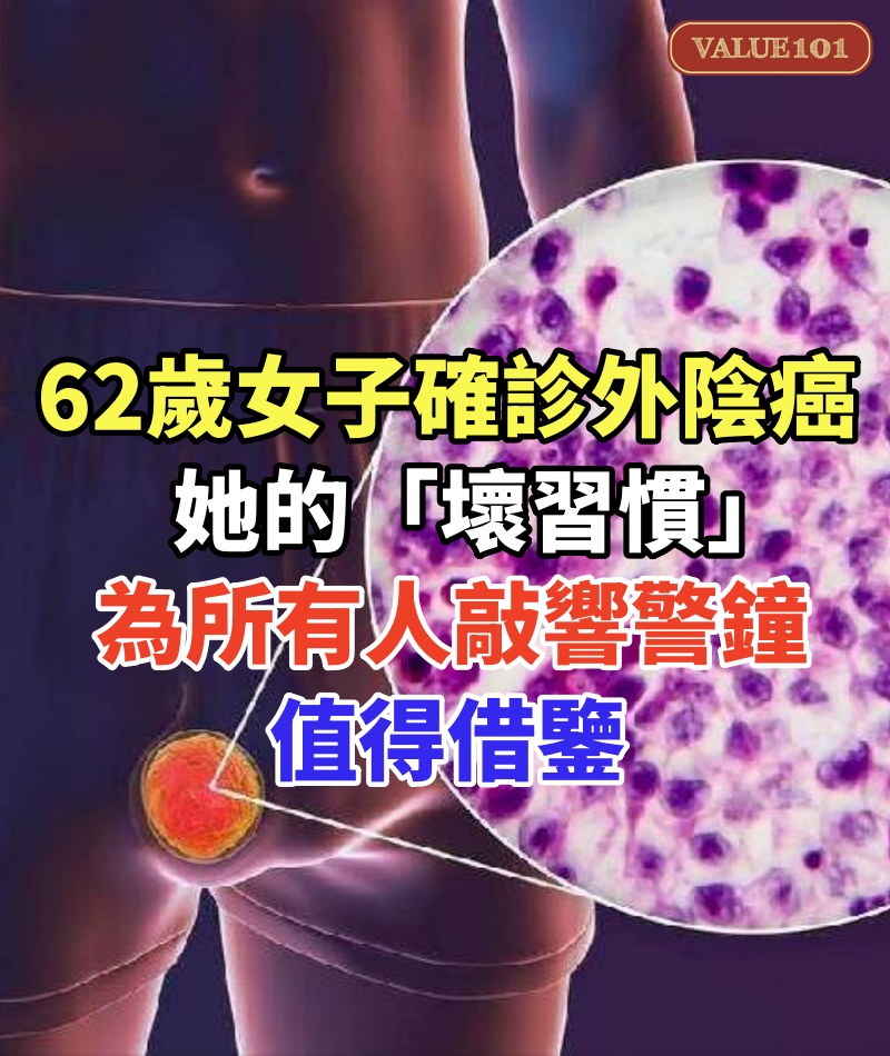 62歲女子確診外陰癌！她的「壞習慣」為所有人敲響警鐘！值得借鑒