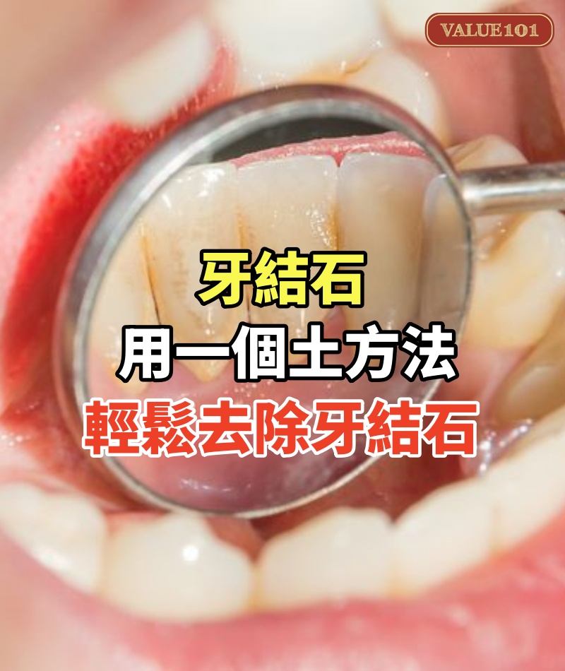 牙結石不要花錢去洗牙！用一個土方法，自己家裡輕鬆去除牙結石！牙結石全部清理乾淨！
