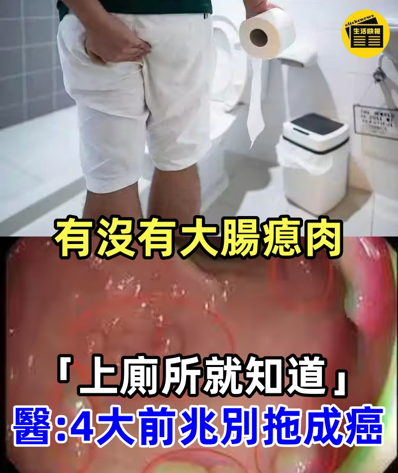 有沒有大腸瘜肉「上廁所就知道」！醫生警告：身體最早「4大前兆」別拖成癌