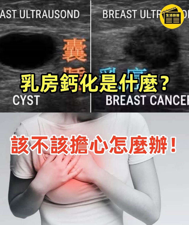 乳房鈣化是什麼？該不該擔心怎麼辦！！