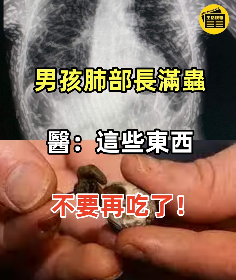 吃一口連同6000隻蟲子吃進肚子！12歲男孩肺部長滿蟲，醫生警告：這些東西不要再吃了！