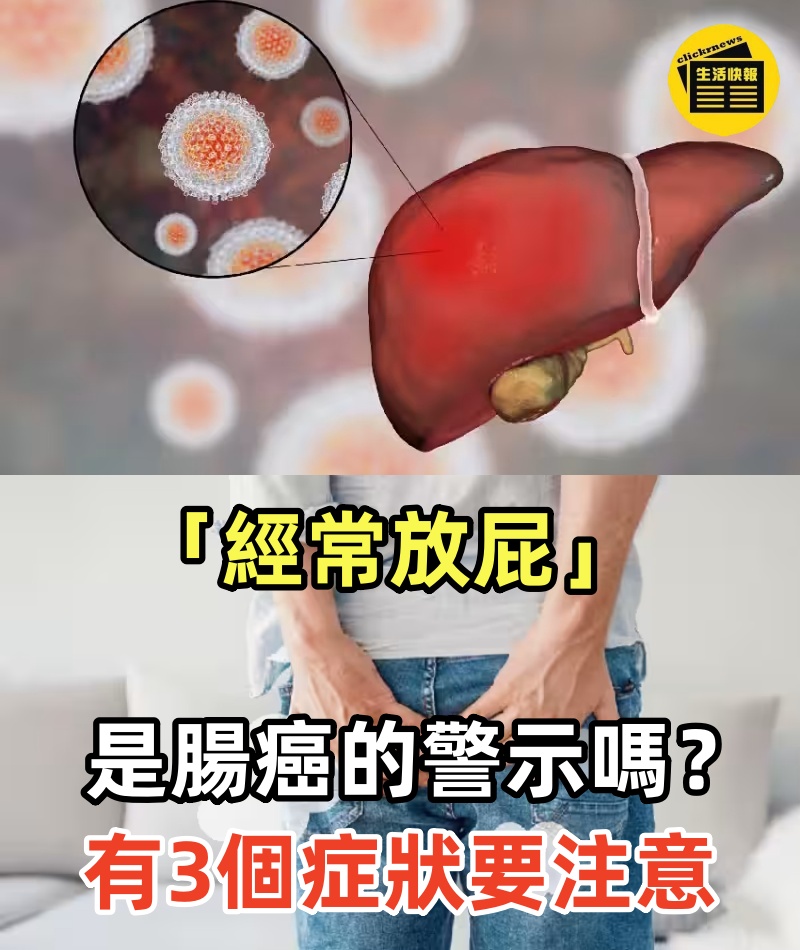 「經常放屁」是腸癌的警示嗎？腫瘤科醫生說 「這3個症狀」才是腸癌信號!