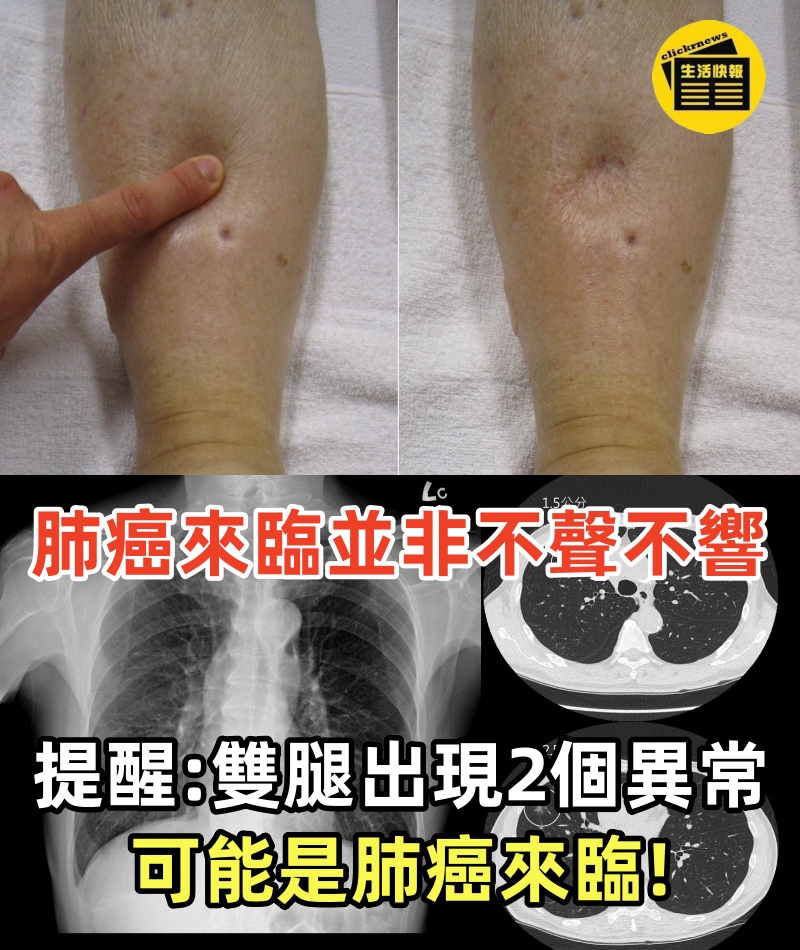肺癌來臨並非不聲不響！提醒：雙腿出現2個異常，可能是肺癌來臨