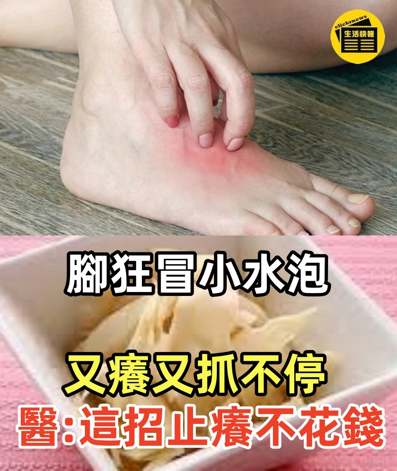 腳狂冒小水泡又癢又抓不停？ 醫提醒：千萬別再抓 這招止癢不花錢