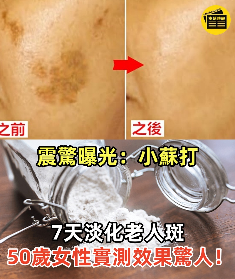 震驚曝光：小蘇打7 天淡化老人斑－50 歲以上女性實測效果驚人！