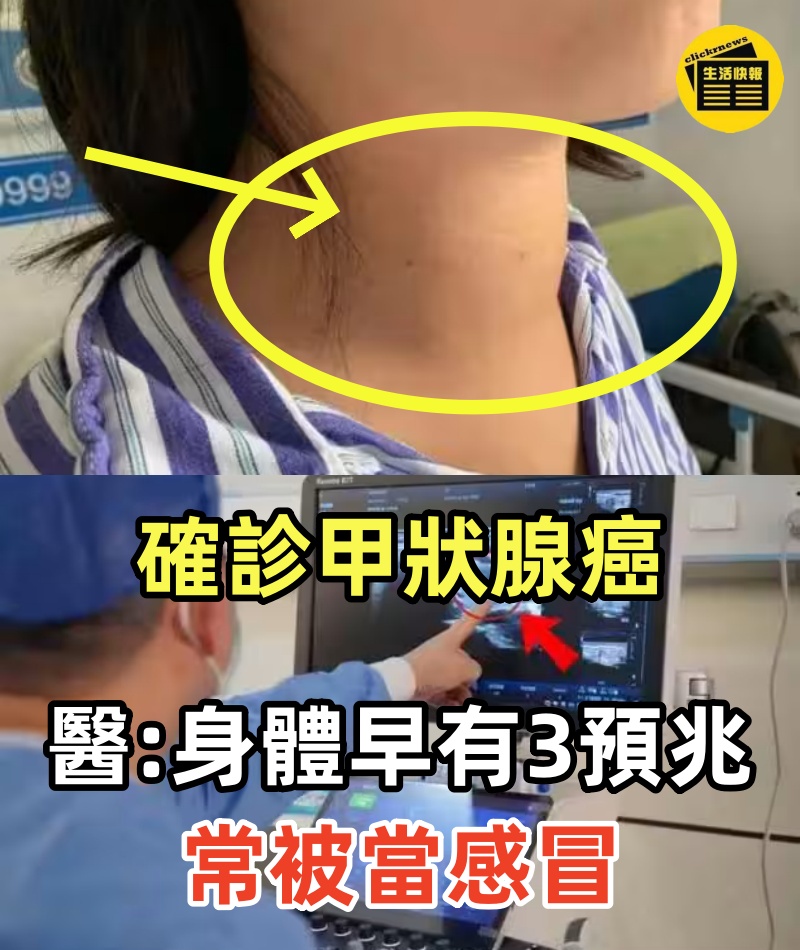 確診甲狀腺癌「最後都是怎麼走的」？！醫生坦言「身體早有3預兆」：常被當感冒
