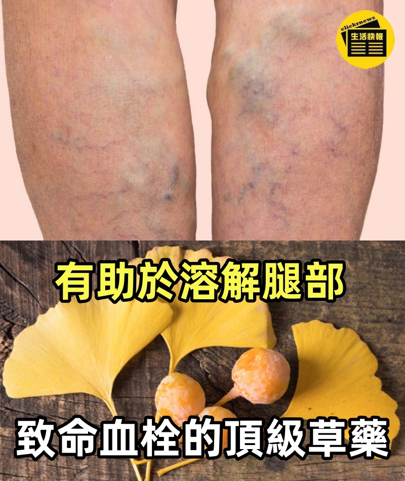 有助於溶解腿部致命血栓的頂級草藥