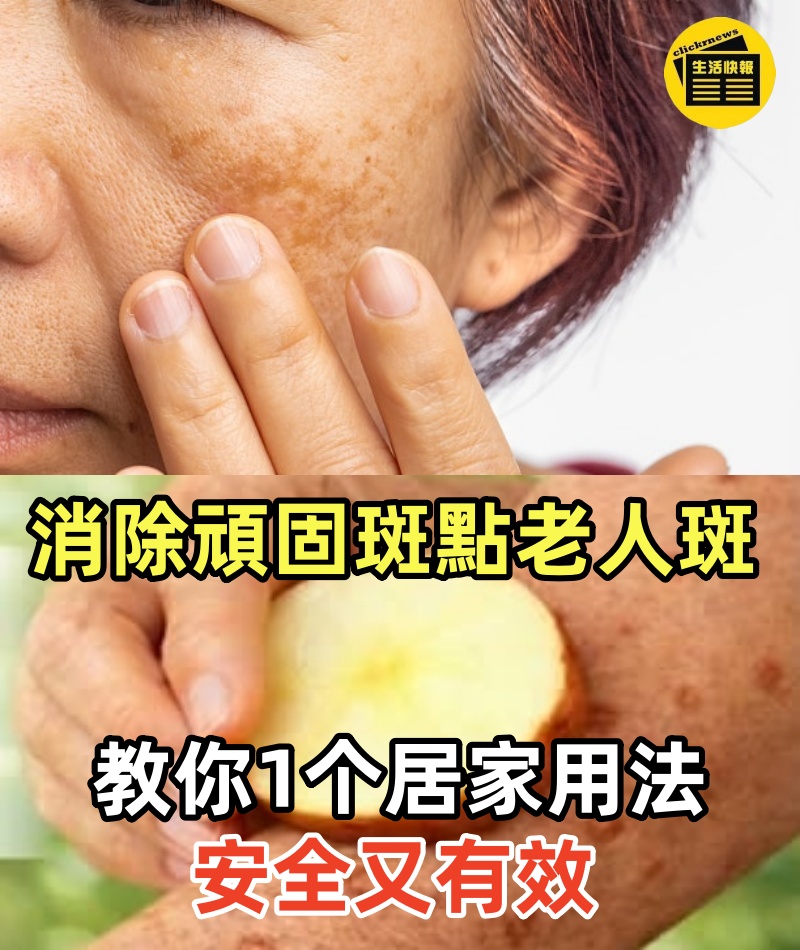 消除頑固斑點老人斑，教你1个居家用法，安全又有效