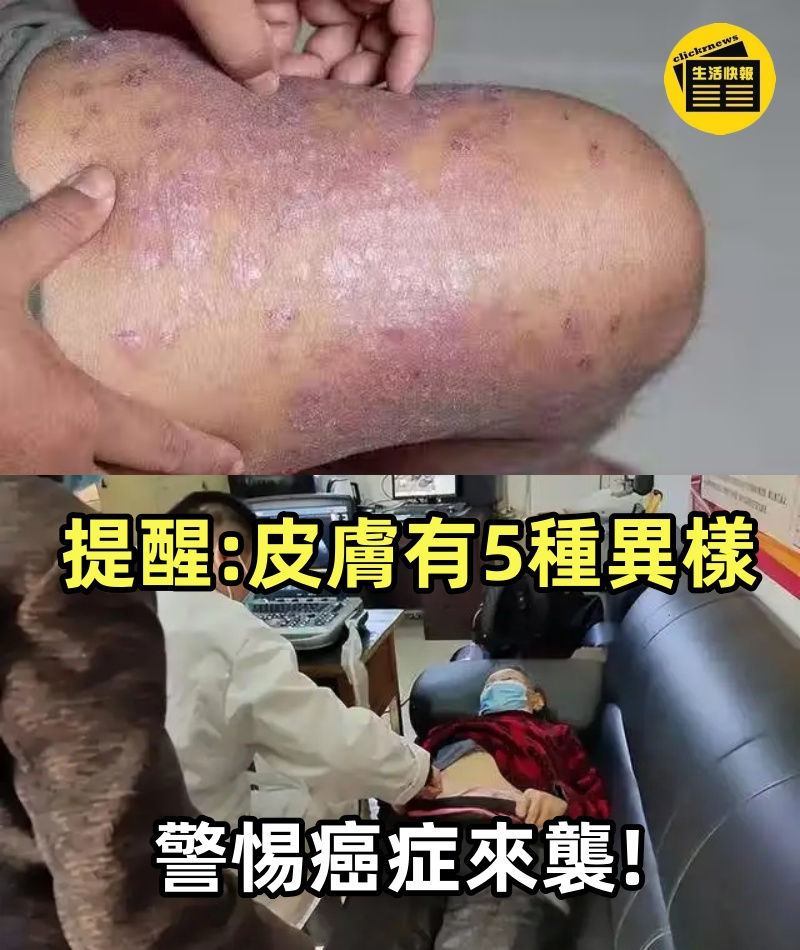 不是皮膚病，而是癌症信號？提醒：皮膚有5種異樣，警惕癌症來襲!