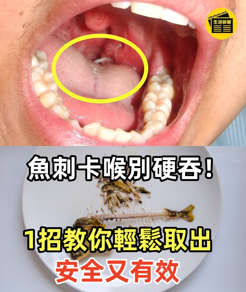 魚刺卡喉別硬吞！1招教你輕鬆取出，安全又有效