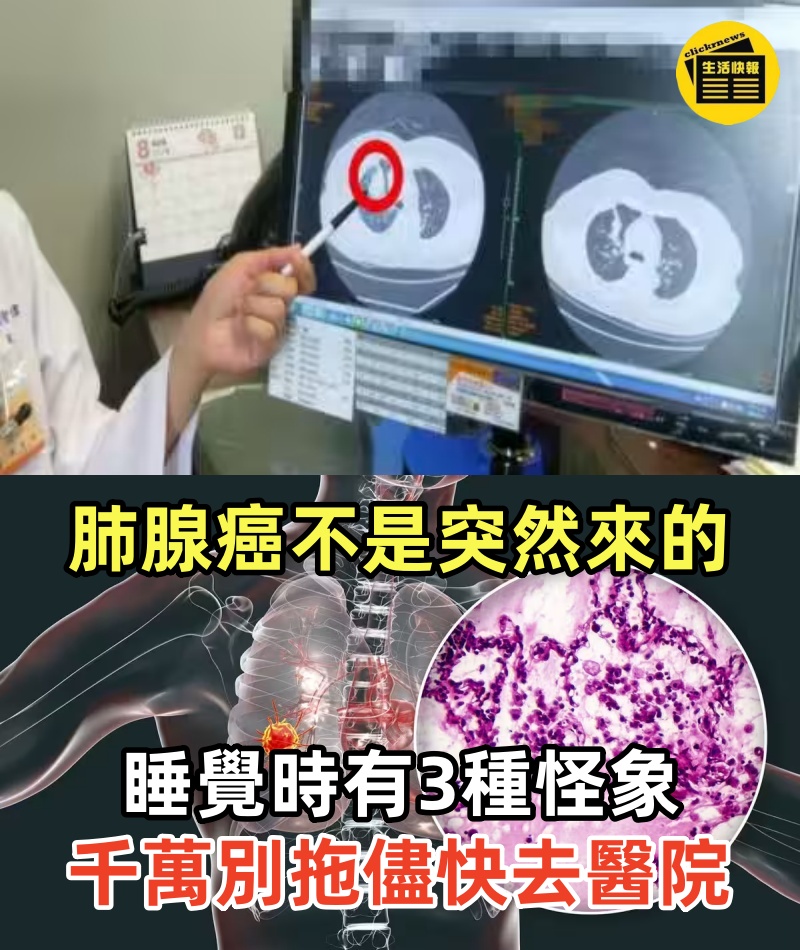肺腺癌不是突然來的!!! 睡覺時身體若有3種「怪象」千萬別拖儘快去醫院， 再不注意就晚了