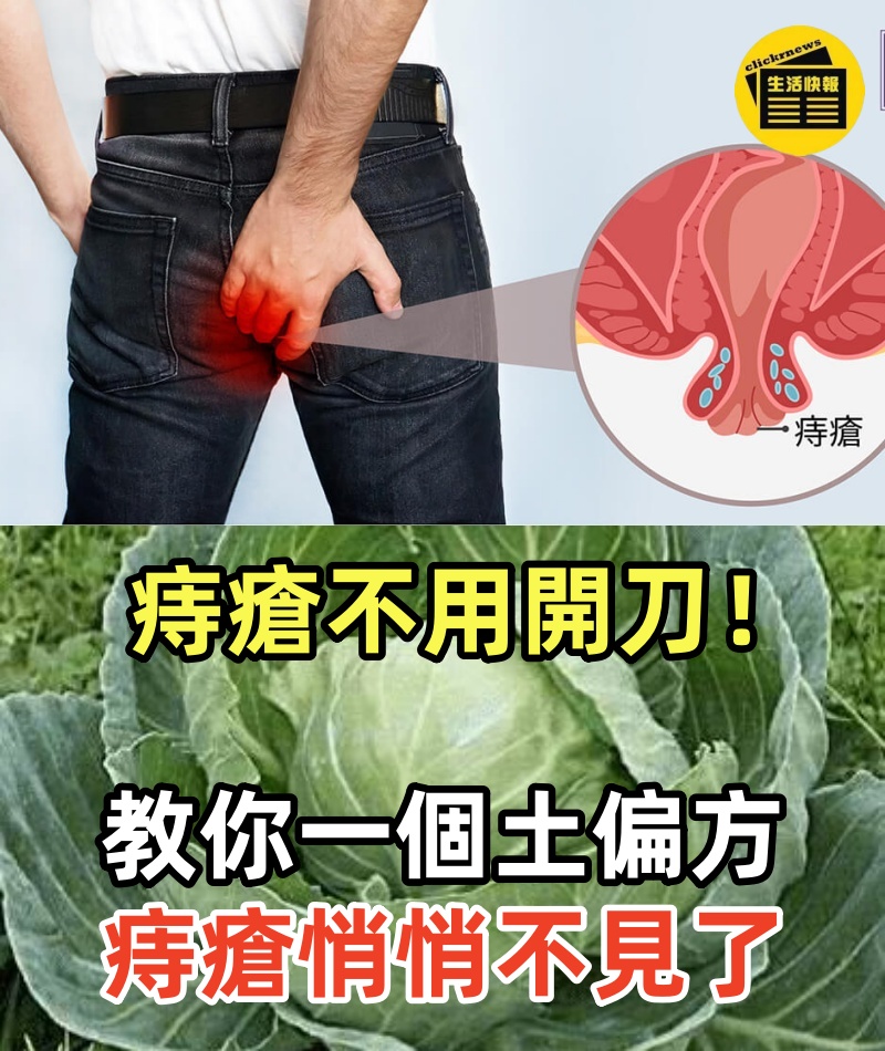 痔瘡不用開刀！教你一個土偏方，十幾年的痔瘡悄悄不見了，連便秘都好了