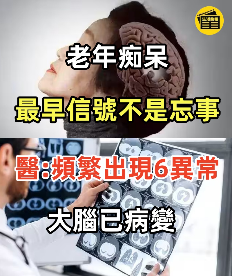 老年痴呆最早信號不是忘事!!! 醫生：頻繁出現這6異常，大腦已病變