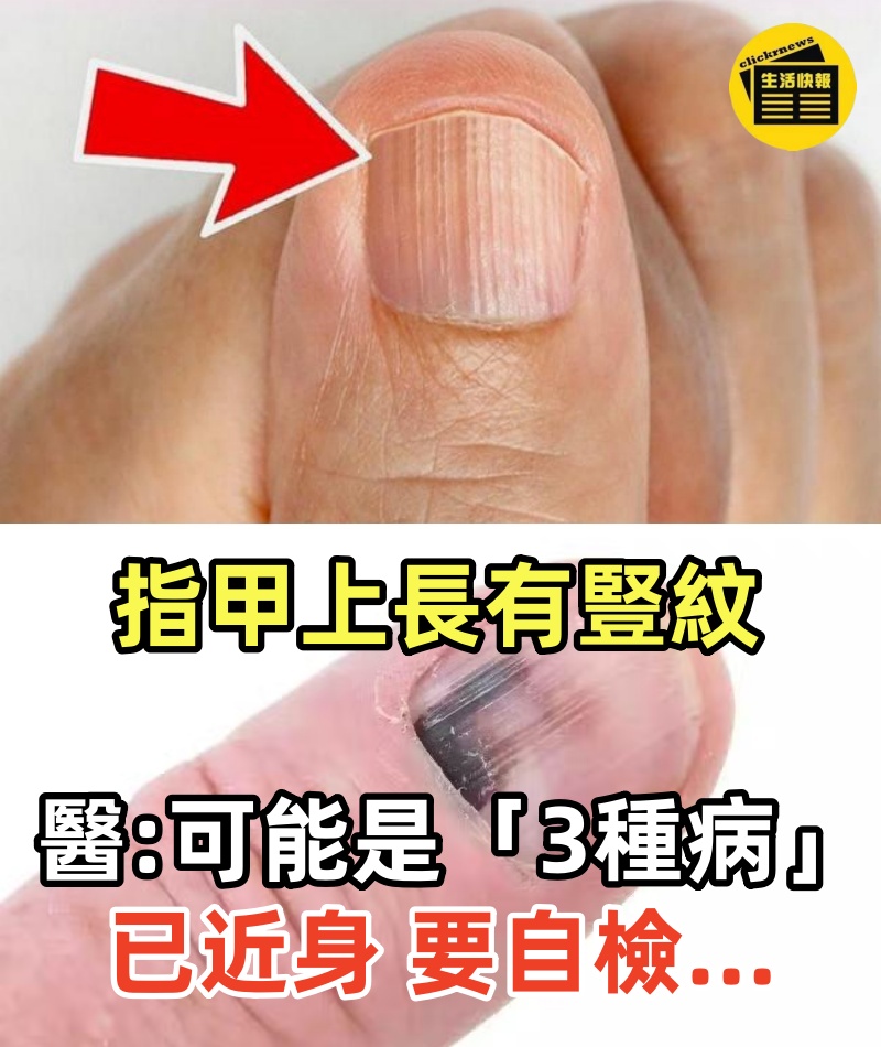 指甲上長有「豎紋」醫生提醒：可能是「這3種病」已近身，要自檢...